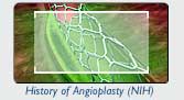 History of Angioplasty