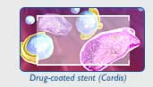 Cordis Drug Coated stent