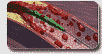 Thrombectomy for Acute MI (Possis Medical)